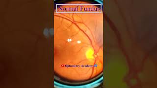 Normal fundus  Normal Retina  Smartphone Fundus Videography  Fundus Photography  Short Video 111 [upl. by Kaja873]