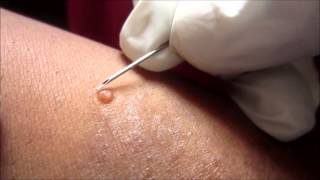 Removing H P Body From Molluscum Contagiosum [upl. by Meean]