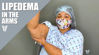 Phases of Lipedema Reduction Surgery  Lymphatic Sparing Arm Lift  Total Lipedema Care [upl. by Eneluqcaj977]