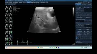 IQ 275 HEPATOMA ICTERUS ULTRASOUND PULMONARY EDEMAEFFUSION [upl. by Kassaraba]