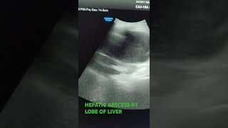 HEPATIC ABSCESS RT LOBE usg [upl. by Olegna]