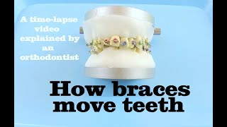 How braces move teeth timelapse  Braces Explained [upl. by Pfeffer679]