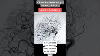 Amazingly beautiful brain angiogram imaging [upl. by Dduj398]