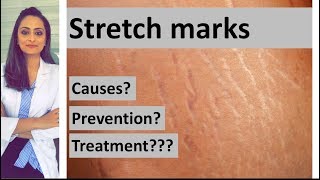 Stretch marks causes prevention treatment  Dermatologist  Dr Aanchal Panth [upl. by Tanney777]