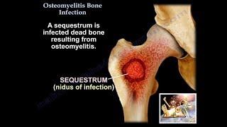 Osteomyelitis Bone Infection  Everything You Need To Know  Dr Nabil Ebraheim [upl. by Anelahs437]