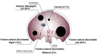 Defects of the Diaphragm Foramen morgagni Hernia Foramen Bockdalek Hernia [upl. by Swords179]