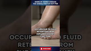 Signs of Kidney Disease You Should Watch Out For shorts [upl. by Negiam653]