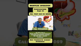 Whipples operation part IV complications best Pancreatic surgeon [upl. by Neelik]