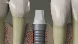 Dental Implants  Replace Missing Teeth  Procedure in Denville NJ [upl. by Doig]