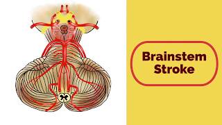 Brainstem Stroke Syndromes [upl. by Halyk]