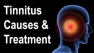 What is Tinnitus Causes amp Treatment Strategies [upl. by Ecydnak]