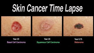 Skin Cancer Time Lapse Basal Cell Carcinoma Squamous Cell Carcinoma Melanoma [upl. by Beaumont]