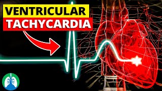 Ventricular Tachycardia Vtach  Medical Explainer Video [upl. by Occor]