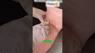 Can a Bee Cure Varicose Veins 😱 [upl. by Eniawed]