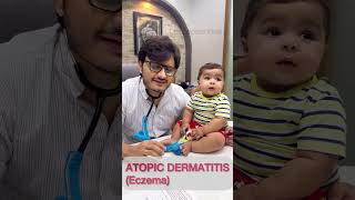 Atopic dermatitis drimranpatel baby shorts doctor [upl. by Adao]