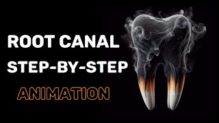 root canal treatment🦷  root canal procedure  rct tretment video  rootcanal  root canal [upl. by Galliett]