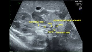 Intestinal Malrotation with Midgut Volvulus in Newborn  Ultrasound [upl. by Arabela192]