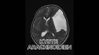 KYSYE ARACHNOIDIEN science femmemedecine radiologystudent info [upl. by Teews]