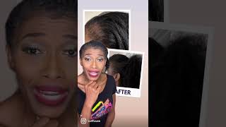 TRACTION ALOPECIA REVERSED [upl. by Charteris]