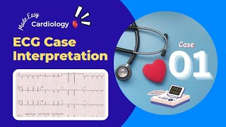 Abnormality in ECG Graph  Discussion about ECG Cases  ECG Cases for Students [upl. by Chloris]