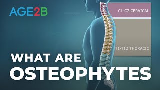 What Are Osteophytes  Spinal Bone Spurs  Anatomy  Degenerative Disc Disease [upl. by Annola]