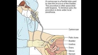 Video Cystoscopy Actual Procedure ENG SUB [upl. by Acemaj]