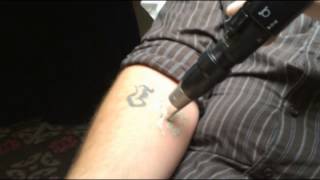 PicoSure Laser Tattoo Removal Demonstration in Toronto  SpaMedicaTV [upl. by Casilde20]