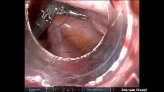 Robotic Assisted Excision of Accessory Cavitated Uterine Malformation [upl. by Adrian]