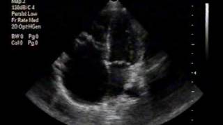 echocardiogramEbstein anomaly apical 4chamber view [upl. by Munster877]