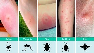 Ouch What Bit Me How to Identify Common Bug Bites and What To Do About It [upl. by Odrude]