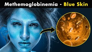 How Methemoglobinemia Effects our body UrduHindi [upl. by Grunenwald939]