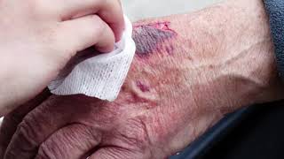 Blood Infection  Symptoms Signs Causes and Treatment [upl. by Alliuqat383]