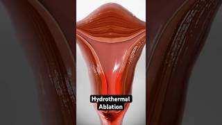 Using heated fluid to stop heavy periods 3D Animation [upl. by Akered]