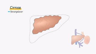 Fordøjelsessystemet Cirrose [upl. by Bruno]