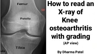 How to read knee joint Xray in knee osteoarthritis  Normal Knee X ray  Ortho X ray interpretation [upl. by Cogen]