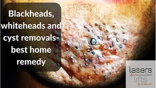 Blackheads whiteheads and cyst removal best home remedies [upl. by Outhe]