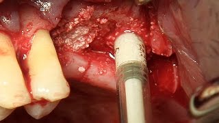 Sinus elevation  Crestal approach using Sinus Elevator amp NR Line system [upl. by Corny]