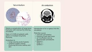 Non thrombotic embolism [upl. by Maroney]