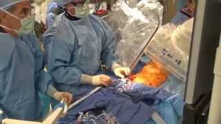 CoreValve Procedure I El Camino Hospital [upl. by Laina839]