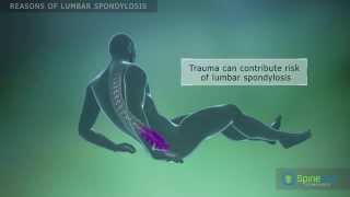 Lumbar Spondylosis Reasons [upl. by Phippen]