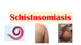 Schistosomiasis  Bilharziasis  Causes Symptoms and Treatment [upl. by Idelle]