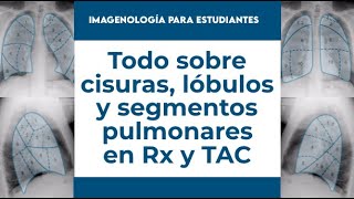 Localización de cisuras lóbulos y segmentos pulmonares en radiografía y TAC [upl. by Eelsnia169]