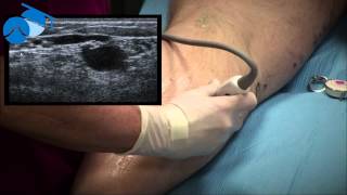 Marking of Small Saphenous Vein SSV and Incompetent Perforating Vein IPV [upl. by Accebor]