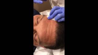 Deep Forehead Lines Removed by Belotero Filler in NYC [upl. by Mendelson671]