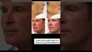 اكسبلور 00447736741700 كيفيه skintagremoval botox skincare beauty [upl. by Eilata]