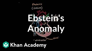 Ebsteins anomaly  Circulatory System and Disease  NCLEXRN  Khan Academy [upl. by Annait]