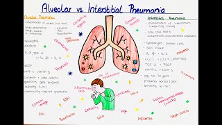 Alveolar vs Interstitial Pneumonia comparison [upl. by Gorlicki]