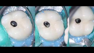 Endodontic access through a porcelain crown 1 [upl. by Mancino160]