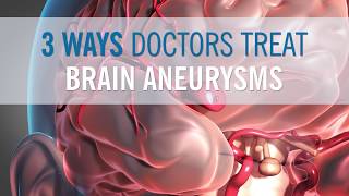 3 Ways Doctors Can Treat Your Brain Aneurysm [upl. by Kuth]