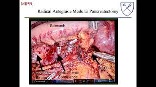 Distal Pancreatectomy [upl. by Yecaw]